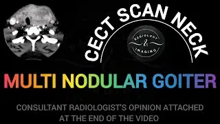 CT Scan Neck Contrast Enhanced