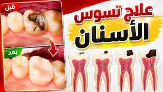 هل تعلم كيف يتم علاج تسوس الأسنان ؟