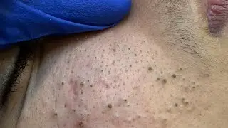 Facial Care Routine For Pimple Treatment (Korean Skincare Secrets)