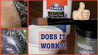 D.I.Y Blackhead Removal Mask!! | 2 INGREDIENTS