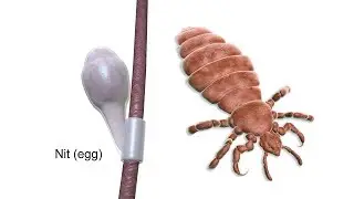 Doctors Won&rsquo;t Tell You This &ndash; Cheap Way to Get Rid of the Head Lice Almost Instantly! ✓