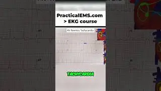 AVRT Explained: Accessory Pathways & Re-entry Tachycardia