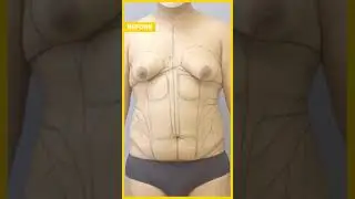 Transgender 360&deg; Transformation Care Before & After Results #liposuction #hourglass #shorts