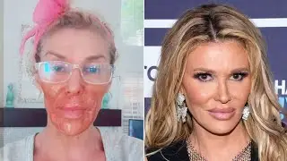 Brandi Glanville&rsquo;s Shocking Face Burn After Parasite &lsquo;Beauty Hack&rsquo; Gone Wrong