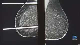 Local breast cancer survivor emphasizes importance of regular mammograms