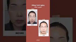 ONYOO's Lifting Surgery Before and After #apgujeong #foreignservices #gangnamclinic