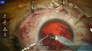 LES OI 97 | ASTIGMATISMO, LASER MIOPIA, CATARATA PRESBICIA, LENTE TRIFOCAL