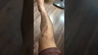 Vỡ Xương B&aacute;nh Ch&egrave; Sau 10 Th&aacute;ng