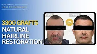 3300 Grafts Hair Transplant | Natural Widow&rsquo;s Peak & Hairline Restoration