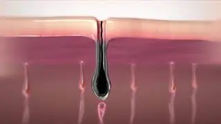 How does Lumina One IPL technology work?