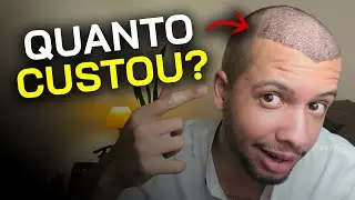 QUANTO CUSTOU MEU TRANSPLANTE CAPILAR EM 2025? RESPONDENDO DÚVIDAS