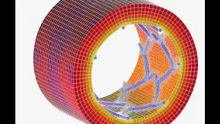 Marc - Stent Insertion Local Remeshing Simulation