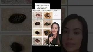 El c&aacute;ncer de piel se puede confundir con lunares, rev&iacute;sate. #skincare #dermatologa #piel #cancer