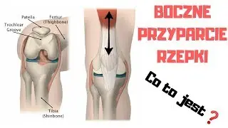 Boczne przyparcie rzepki - Co to jest❓