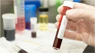 VIH/sida&nbsp;: un tiers des d&eacute;pistages sont trop tardifs | Jorge