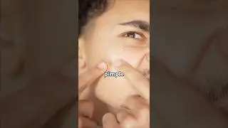 The Quickest Way to Get Rid of Pimples