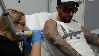 Tattoo Artist Gets Tattoo Removal on Sleeve - First Treatment