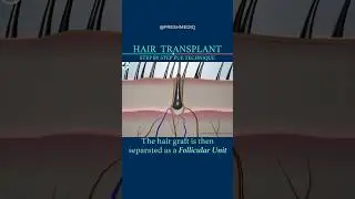 How FUE Hair Transplant Works