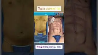 Abdominal Etching Male