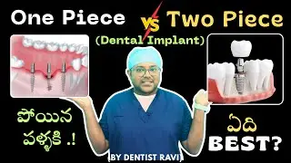 Missing Teeth Treatment In Telugu| పోయిన పళ్ళకి Best ఆప్షన్స్ ఏంటి?| Full Mouth Dental  Implants 