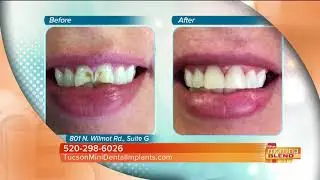 Tucson Mini Dental Implants