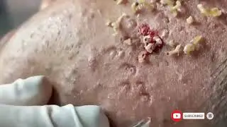 Relax Every Day With Sac Dep Spa | Blackhead removal on face | Dep sac spa