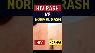 Сыпь при ВИЧ и обычная сыпь &mdash; как определить разницу?