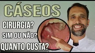 Amigdalectomia? Sim ou Não? QUANTO CUSTA?