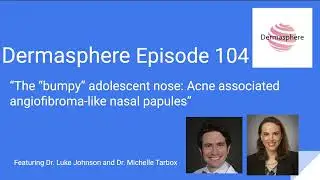 Acne-Associated Angiofibroma like Nasal Papules  Presentation, Histopathology, and Causes