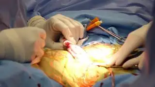 Natural Scar Subcoronal No-Touch Titan Penile Implant Surgery Atlanta 4K