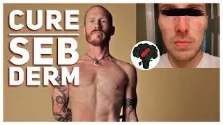 How To Cure Seborrheic Dermatitis Permanently