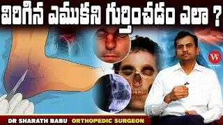 విరిగిన ఎముకని గుర్తించడం ఎలా ? (Sprain) Bone Fractures Types, Symptoms & Treatment Dr Sharath Babu