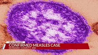 Confirmed Measles case
