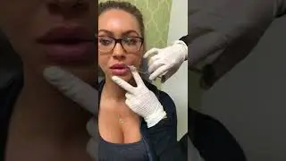 Lip injections with Juvederm Voluma