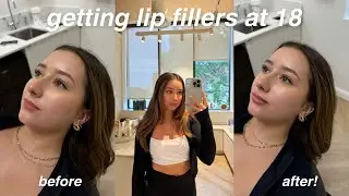 GETTING LIP FILLERS AT 18 | before & after