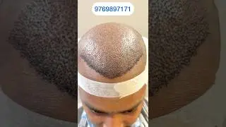 Covering full area by DHI method hair transplant