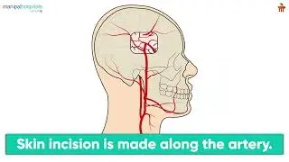 Life-Saving Brain Bypass Surgery Explained | Step-by-Step Guide to STA&ndash;MCA Bypass & Recovery
