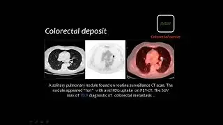 Basics of PET CT   Dr Mamdouh Mahfouz In Arabic
