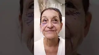 Barbara's 4-Day EVE Lift&trade; Progression | Eden Plastic Surgery: Dr. Ali Charafeddine, MD