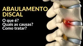 Abaulamento Discal | O que &eacute;? Quais os sintomas? Como tratar?