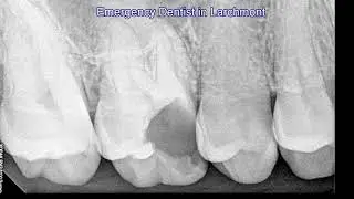 Emergency Dentist in Larchmont | Get the Help You Need