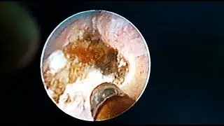 Endoscopic Renal Parenchyma Tunnel Cauterization  using a 3-Fr basket