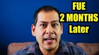 Hair Transplant 2 Months After- FUE Results: Dr Cortez Tijuana Mexico