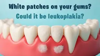 White patches on your gums? Could it be leukoplakia?