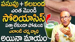 Psoriasis Treatment in Telugu | Madhusudhan Sharma | iD Health Focus