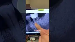 Two other endodontists couldn&rsquo;t help this patient. 