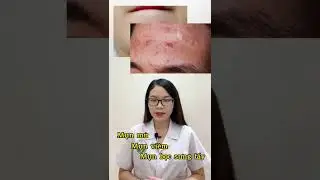 4 Loại thuốc b&ocirc;i trị mụn được c&aacute;c Bs da liễu khuy&ecirc;n d&ugrave;ng