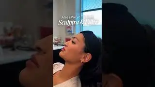 Sculptra & Filler at RISE Medspa in Houston, TX