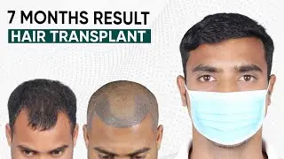 Hair Transplant in Chennai (HX-TYVE) | Best Results & Cost of Hair Transplant in Chennai