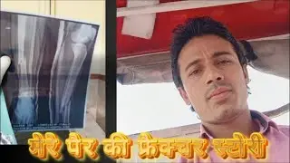 Are you going through fracture recovery time? Don't worry Join Live for my experience#fracture tibia